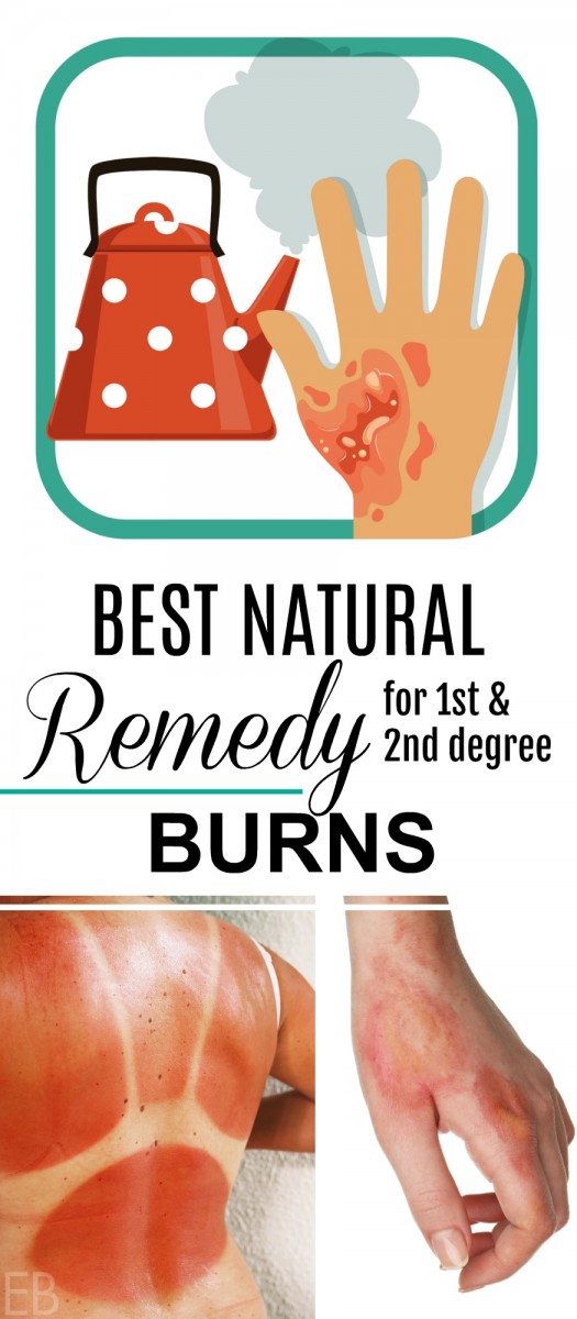 Best Home Remedy for Burns Real Vanilla Extract (Why and How to Use It