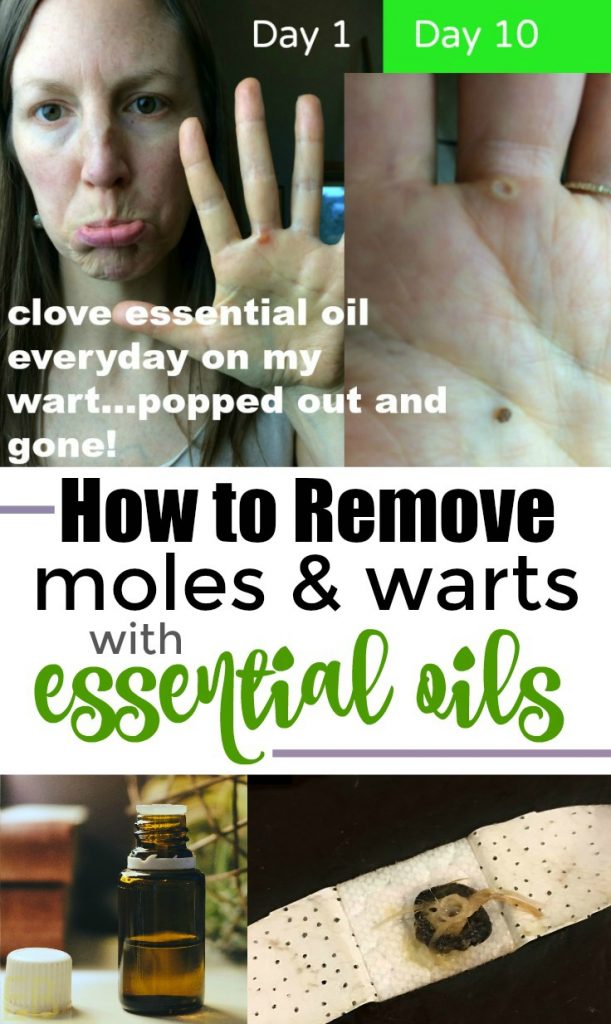 How to Remove Moles and Warts with Essential Oils {with step-by-step method} #wartremoval #moleremoval #essentialoils #EOremedies #howtoremove #herbalremedies