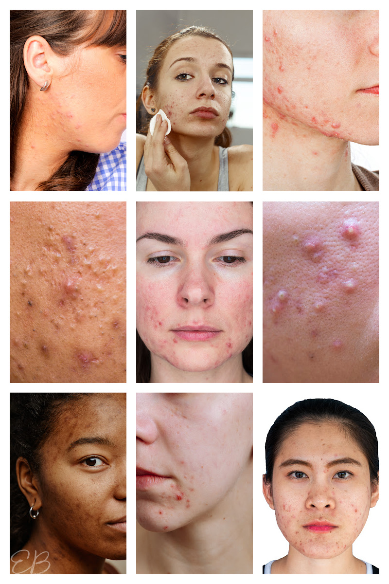 9 images of deep pimples (or cystic acne) up close on different people's faces
