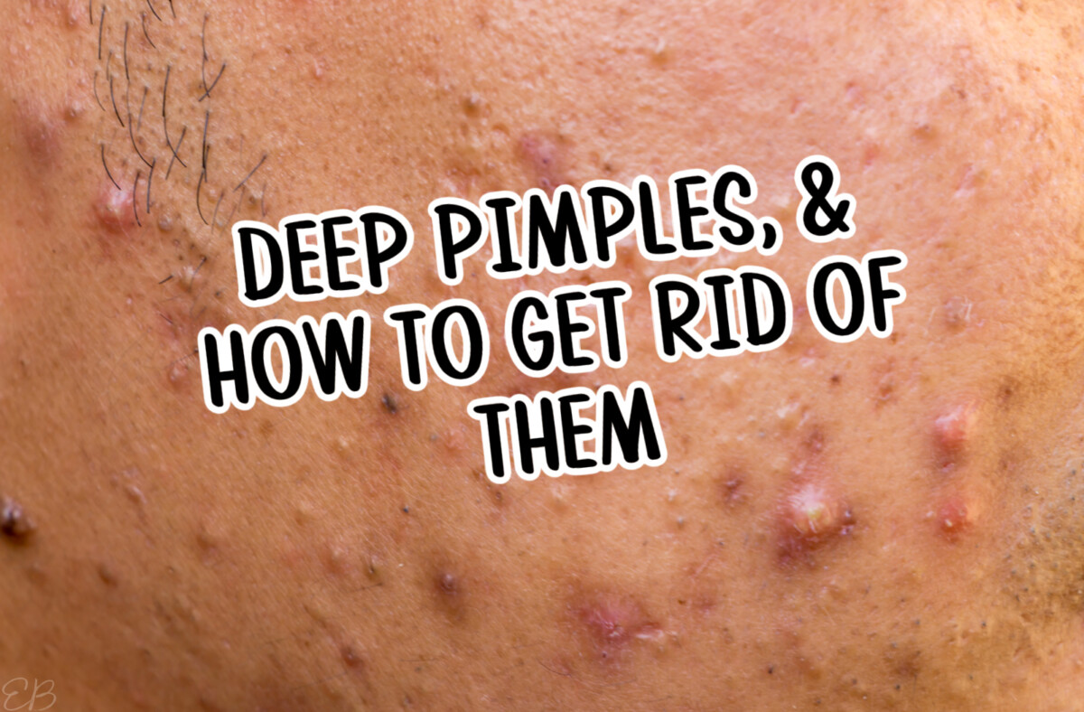 man's cheek with cystic acne, and wording overlay that reads: Deep Pimples, and How to Get Rid of Them